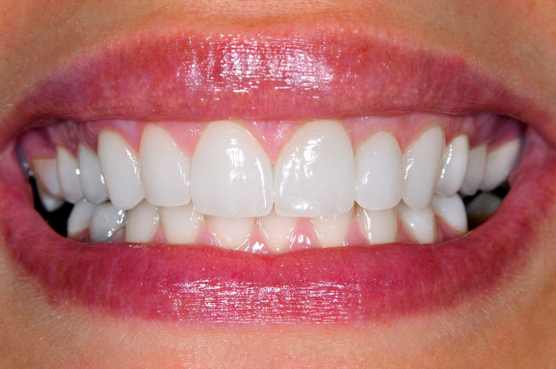 Teeth Whitening Holidays
